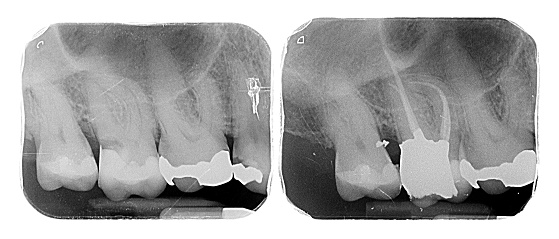 Root Canal (Endodontic) Treatment Croydon
