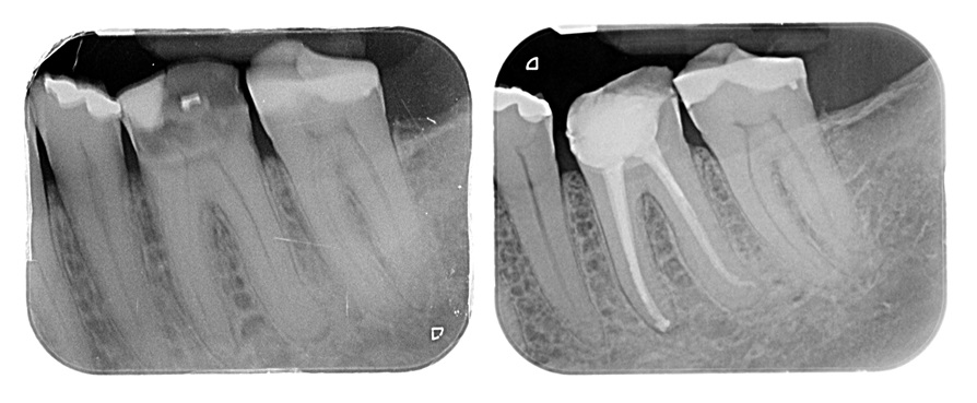 Root Canal (Endodontic) Treatment Croydon