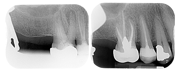 Root Canal (Endodontic) Treatment Croydon