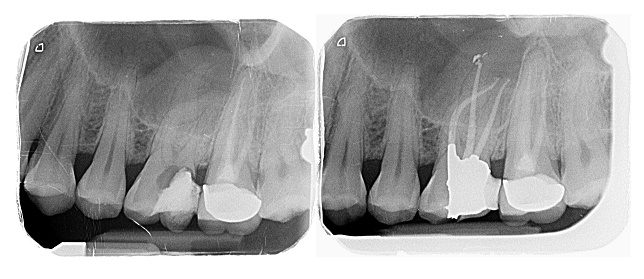 Root Canal (Endodontic) Treatment Croydon