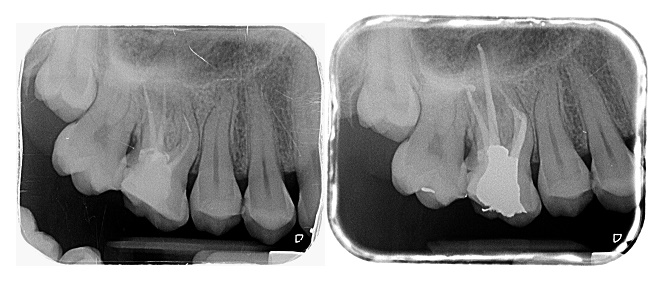 Root Canal (Endodontic) Treatment Croydon