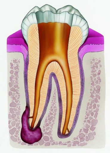 Root Canal (Endodontic) Treatment Croydon