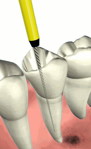 Root Canal (Endodontic) Treatment Croydon
